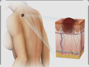 MOSTAR, 9. svibnja (FENA) – Povodom Europskog dana borbe protiv melanoma, specijalistica dermatoverologije i vršiteljica dužnosti predstojnice Klinike za kožne i spolne bolesti Sveučilišne kliničke bolnice (SKB) Mostar dr. Marina Čović upozorila je u razgovoru za Fenu na zabrinjavajući porast broja oboljelih od melanoma, najagresivnijeg oblika raka kože.(Foto FENA/Mario Obrdalj)